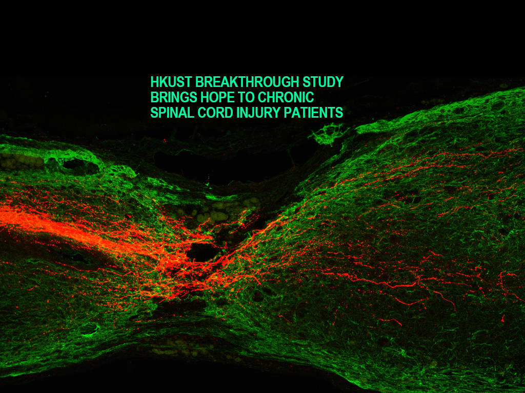 New scientific treatment gives hope to chronic spinal cord injury patients